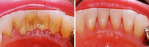 Процедуры чистки и удаления зубного камня.